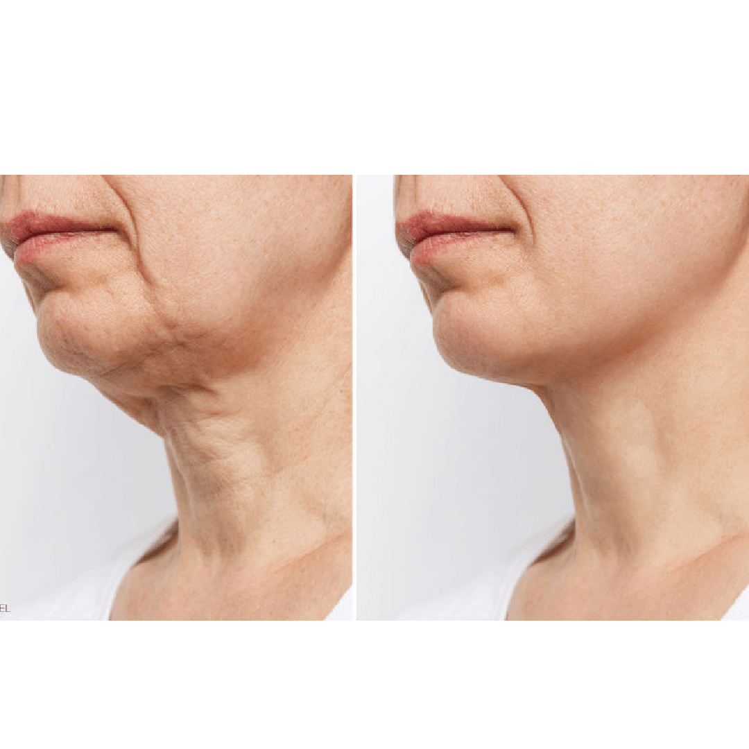 Ageing & the Neck