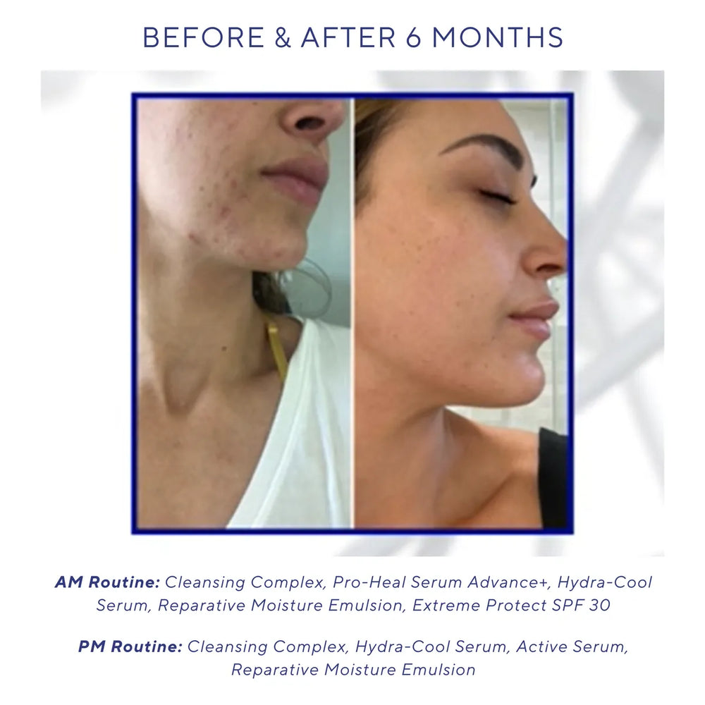 Side-by-side comparison of a woman's lower face before and after six months of iS Clinical Cleansing Complex skincare routine