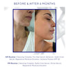 Side-by-side comparison of a woman's lower face before and after six months of skincare routine