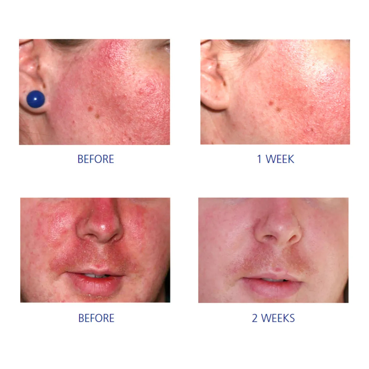 Four close-up photos showing facial redness before and after using iS Clinical Pro-Heal Serum Advance+ over one and two weeks