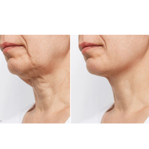 Side-by-side comparison of a woman's lower face and neck showing reduced sagging and smoother skin texture