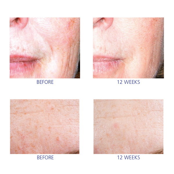 Close-up comparison of facial skin before and after 12 weeks of using iS Clinical Active Serum, showing texture and pigmentation changes